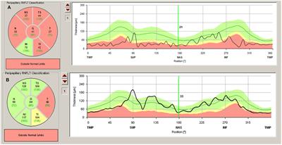 The Contribution of Optical Coherence Tomography in Neuromyelitis Optica Spectrum Disorders